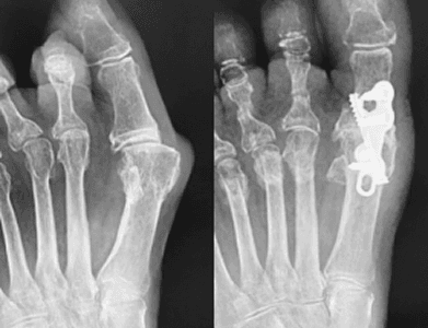 Arthrodesis bunion fusion procedure