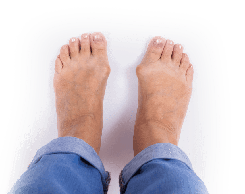 Bunion diagram showing deformity