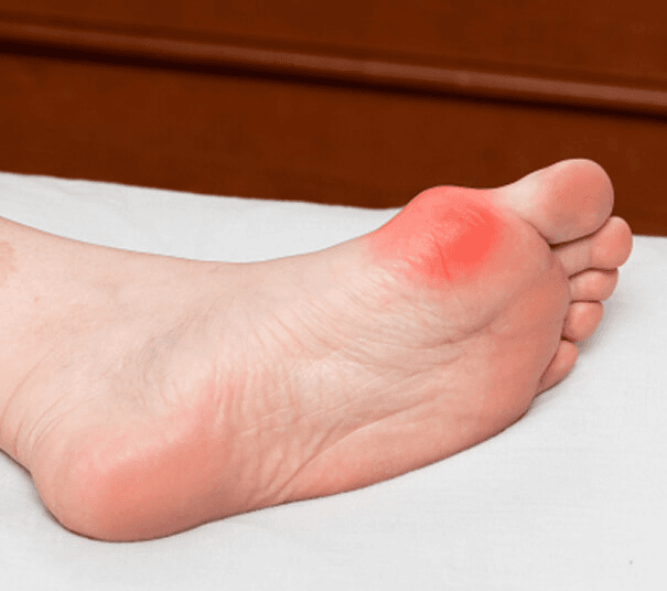 Bunion anatomy and joint alignment