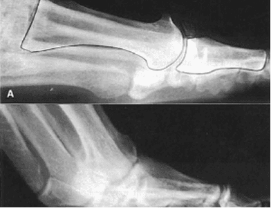 Bunionectomy surgical procedure