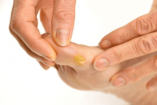 Corn removal surgical procedure