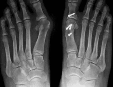 Exostectomy bone spur removal