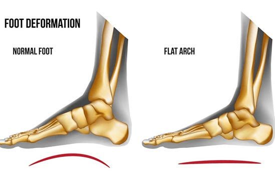 Flat foot anatomy and structure