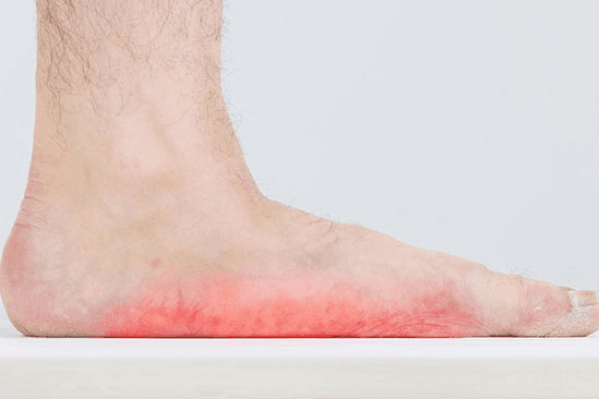 Flat foot treatment and care