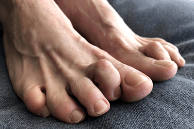 Hammertoe deformity and condition