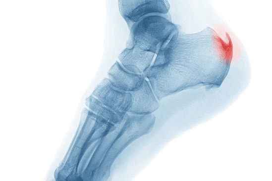 Heel spur condition and anatomy