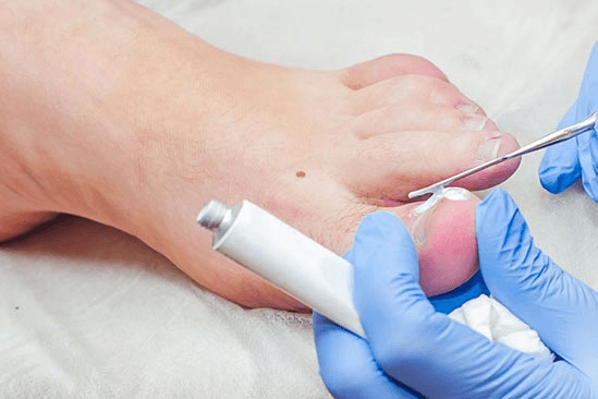 Medical professional treating an ingrown toenail