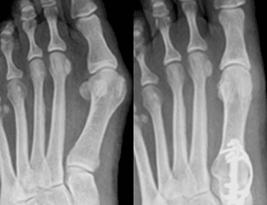 Lapiplasty bunion correction technique