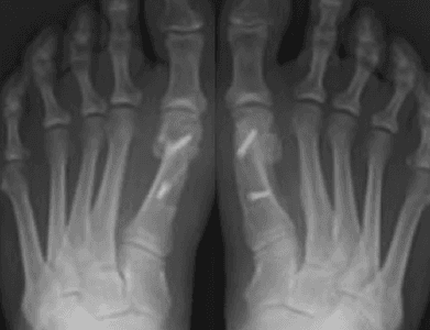 Osteotomy bone realignment surgery