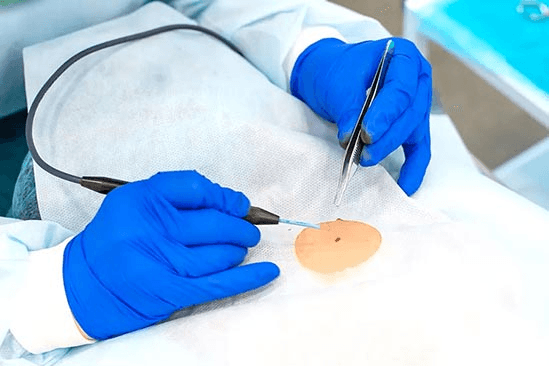 Plantar wart treatment procedure