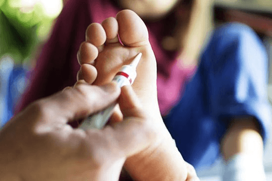 Plantar wart on the sole of the foot