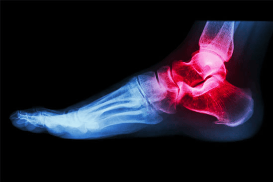 Illustrated foot X-ray highlighting ankle and heel areas treated by podiatric procedures