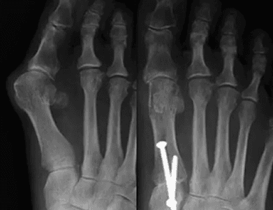 Resection arthroplasty joint procedure