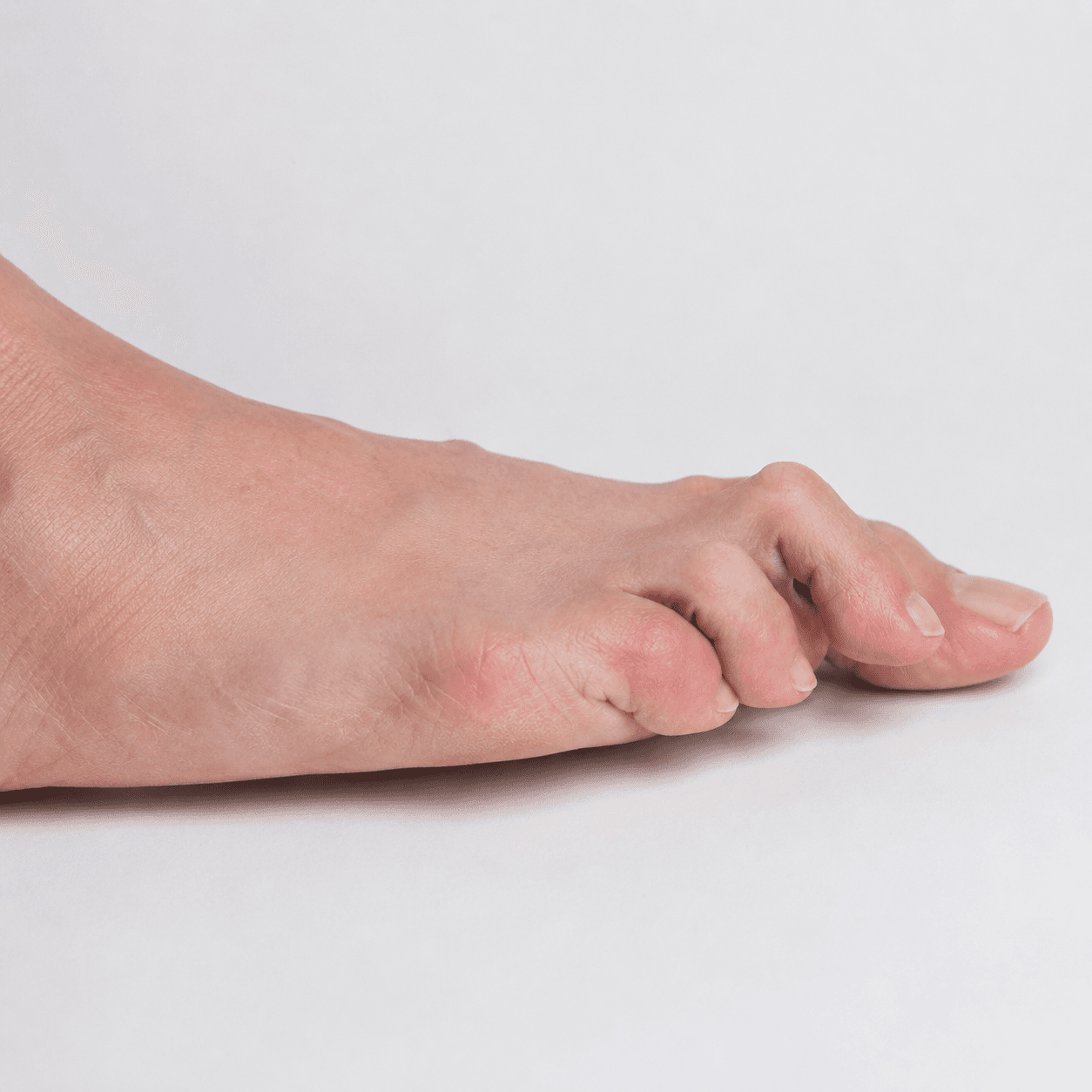 Hammertoe treatment and correction