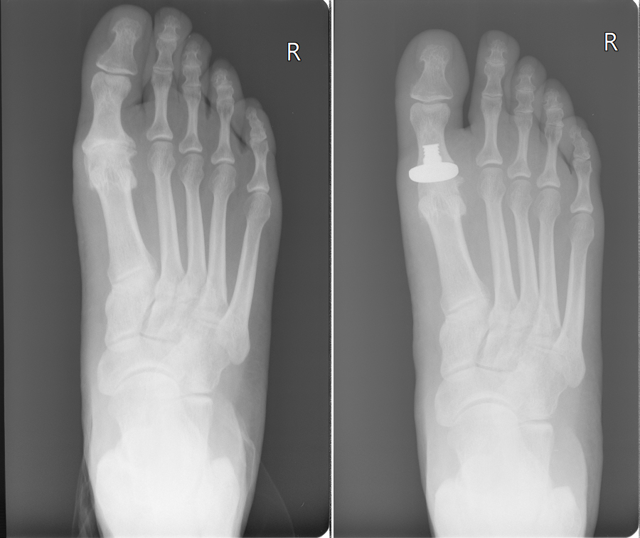 Bunion Surgeon Specialist NYC Best Bunion Surgeon Brooklyn Bunion Surgeon Specialist NYC Best Bunion Surgeon Brooklyn