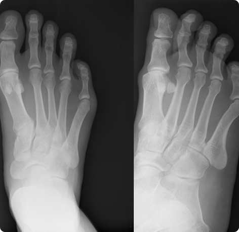Pre op AP view hammer toes 2-5